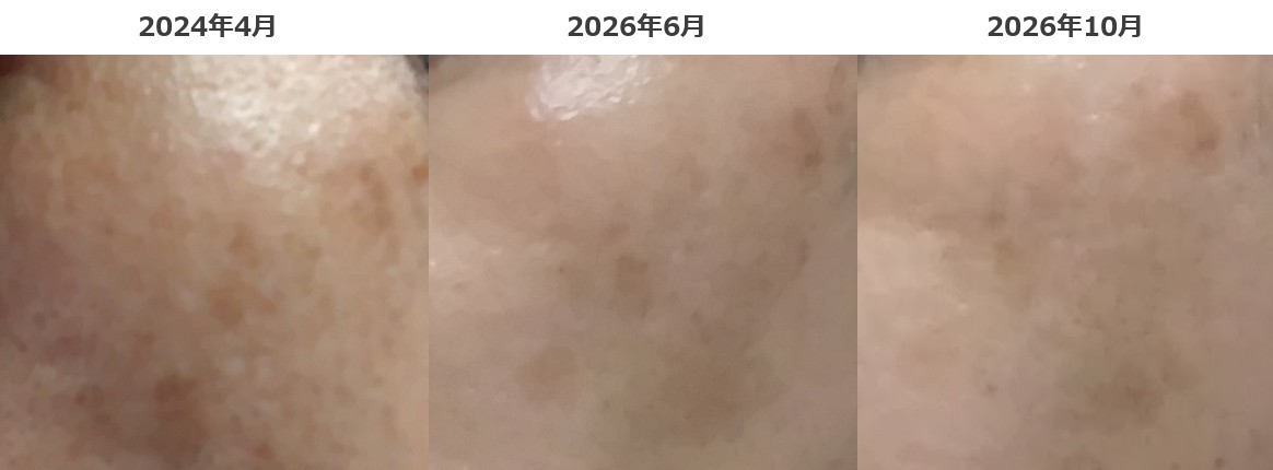 インナーシグナル使用中の左こめかみ〜ほほのシミの比較。2024年4月、2026年6月、2026年10月